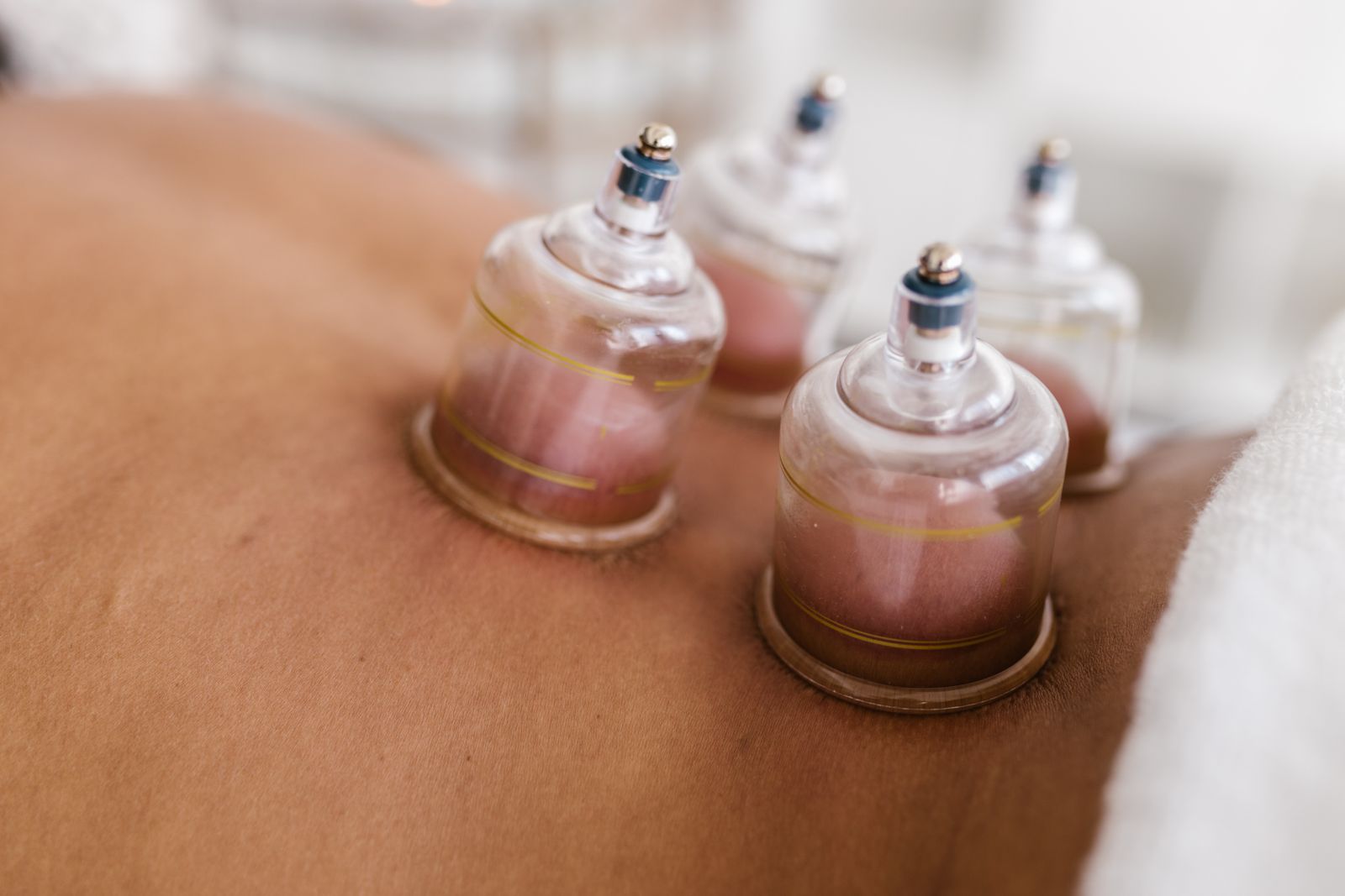 Glass cups set on a patient’s back during a cupping session