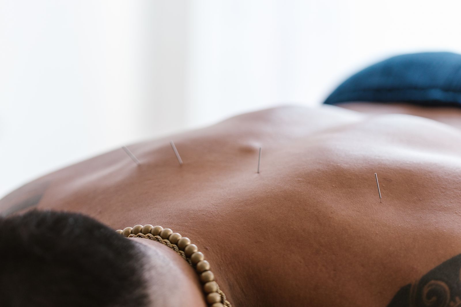 Acupuncture needles resting along the upper back of a patient lying face down